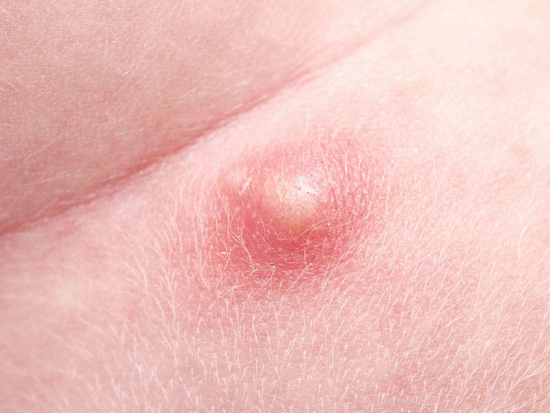 Pimple with puss on penis