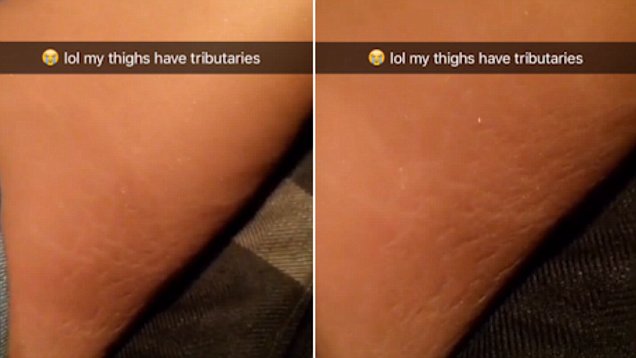 Stretch marks on thighs porn