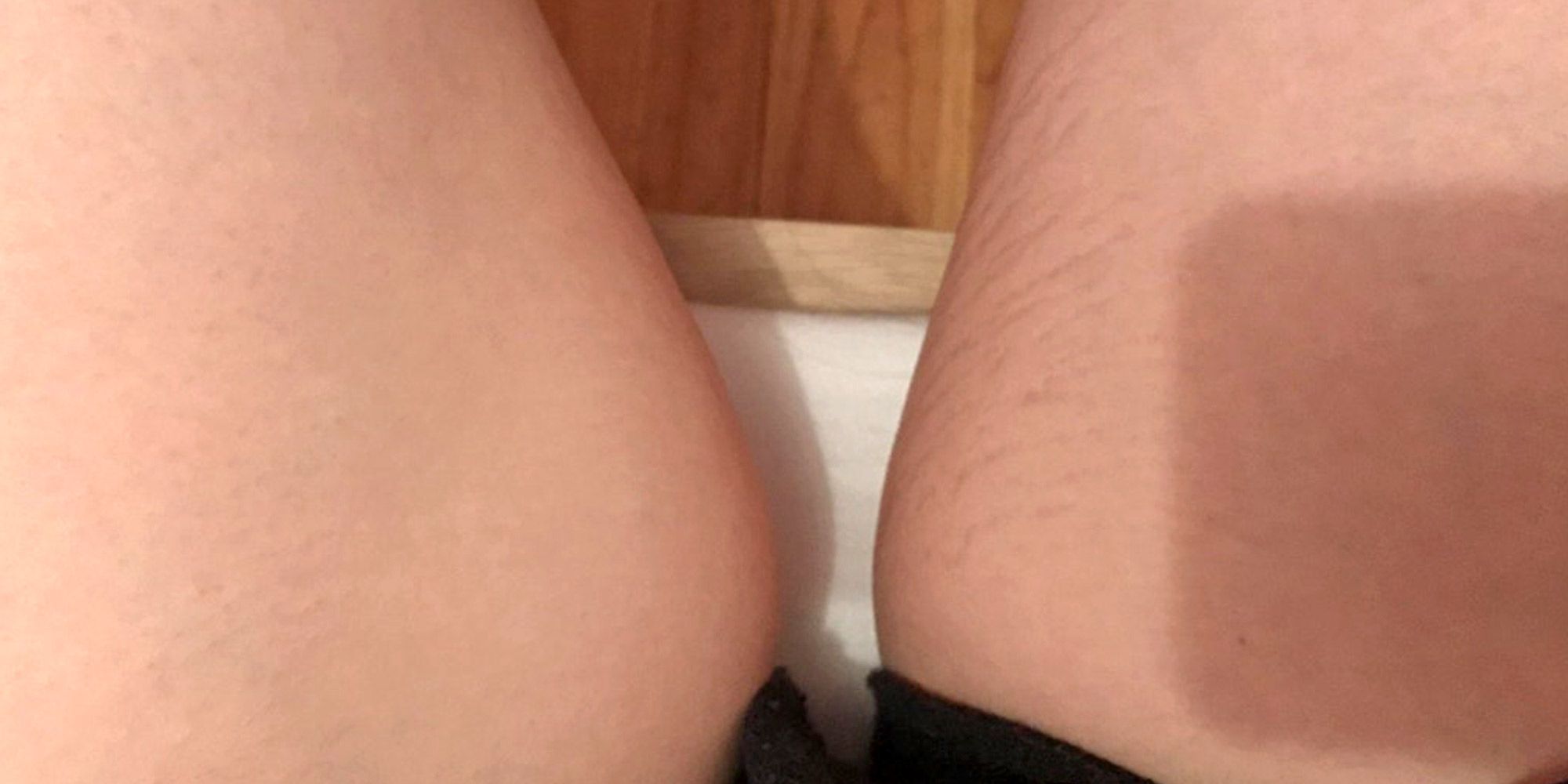 Stretch marks on thighs porn