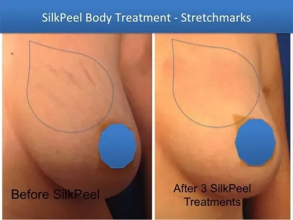 Stretch mark tits boobs breasts