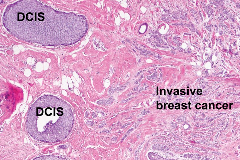 Dcis and breast cancer