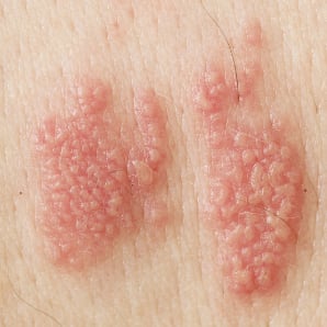 Penis on herpes signs early of