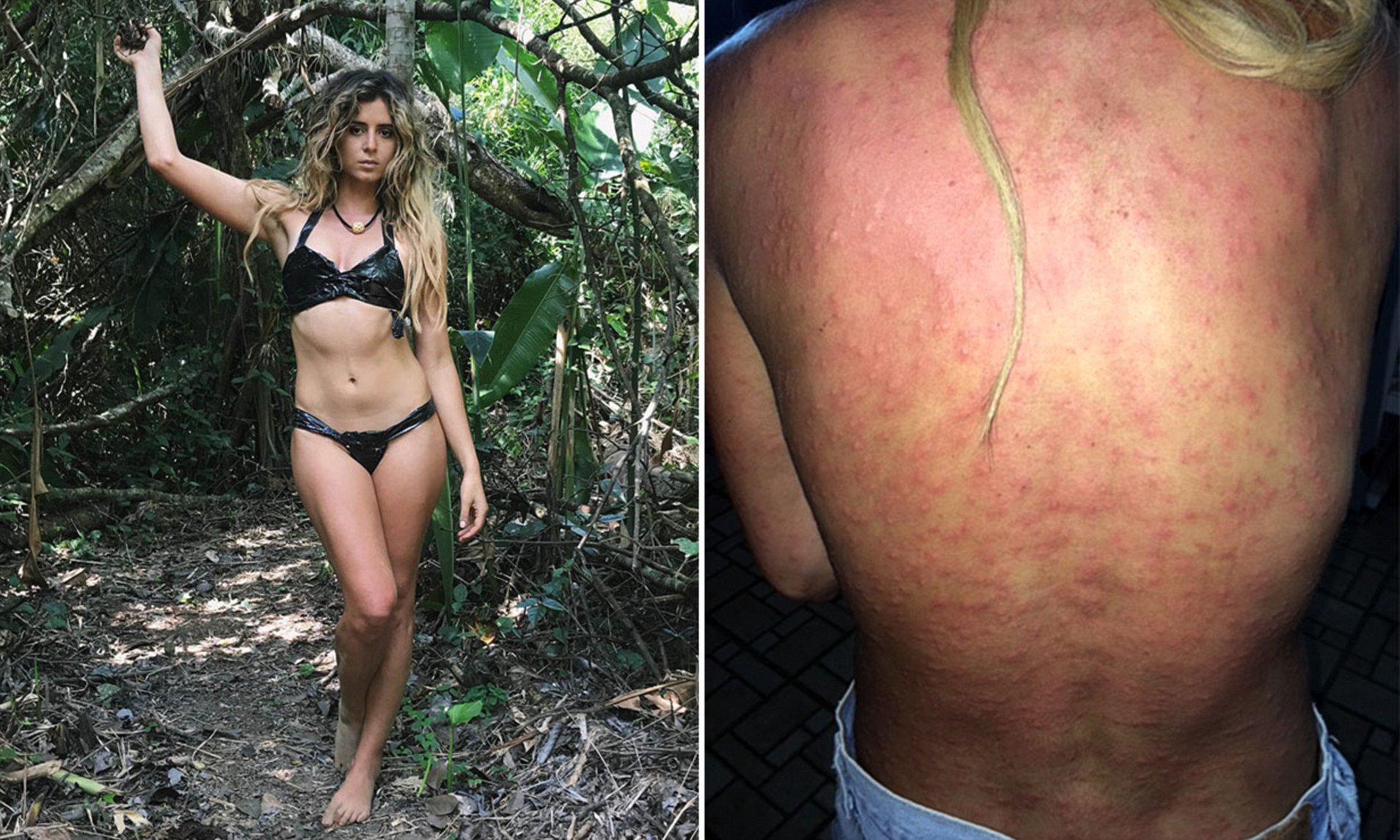 Mosquito bites nude porn