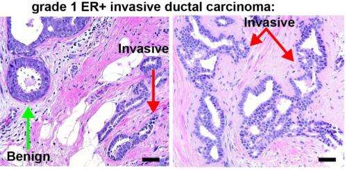 Carcinoma invasive breast cancer