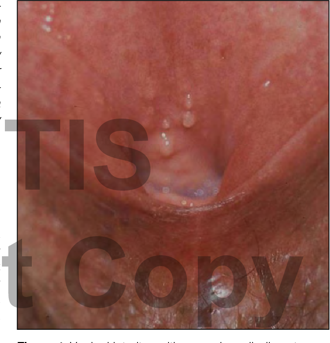 Genital picture vulva wart