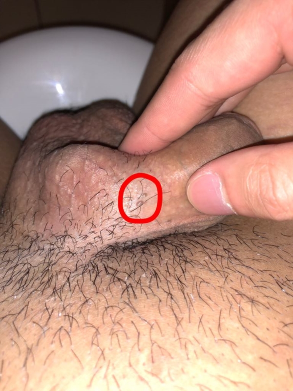 Shaft wart on my penis