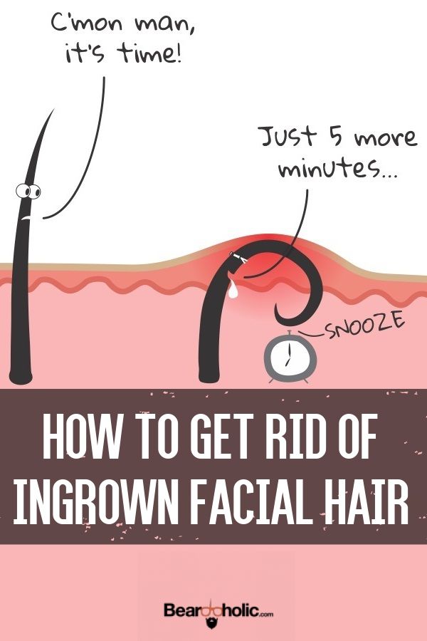 Get rid of ingrown facial hair