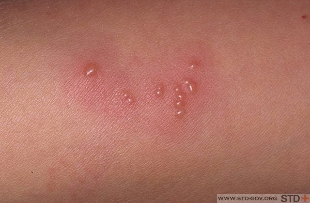 Penis on herpes signs early of
